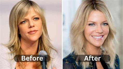 kaitlin olsen plastic surgery|Kaitlin Olson Botox And Face Lift: Before And After。